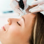 Can Fractional RF Micro Needling Smooth Fine Lines