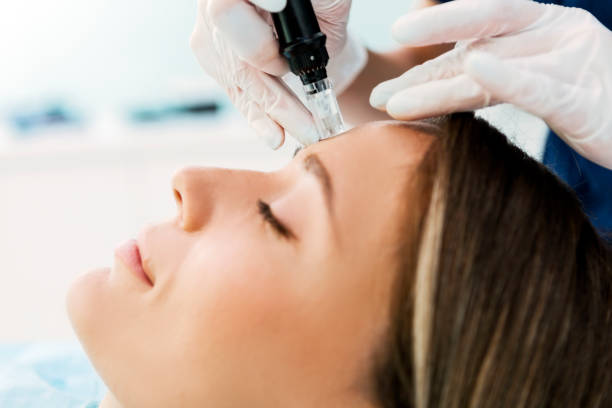 Can Fractional RF Micro Needling Smooth Fine Lines