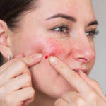 Can Laser Acne Scar Treatment Minimize Scar Pores