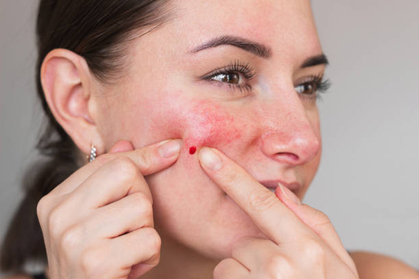 Can Laser Acne Scar Treatment Minimize Scar Pores
