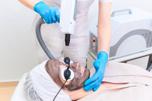 Can Laser Carbon Peel Help Improve Skin Radiance