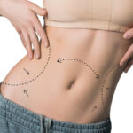 Can Mini Tummy Tuck Help With Stubborn Lower Belly
