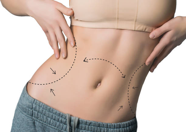 Can Mini Tummy Tuck Help With Stubborn Lower Belly
