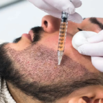 Beard Hair Transplant in Abu Dhabi