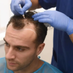 Hybrid Hair Transplant in Abu Dhabi