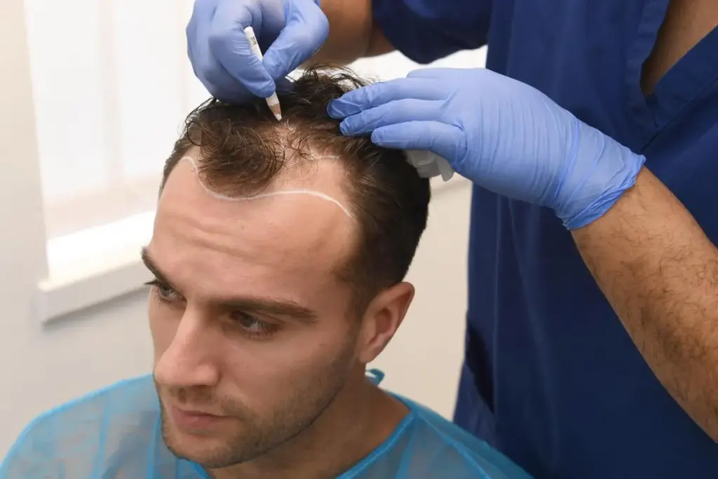 Hybrid Hair Transplant in Abu Dhabi