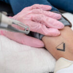 Does Laser Tattoo Removal Work on Multicolored Ink