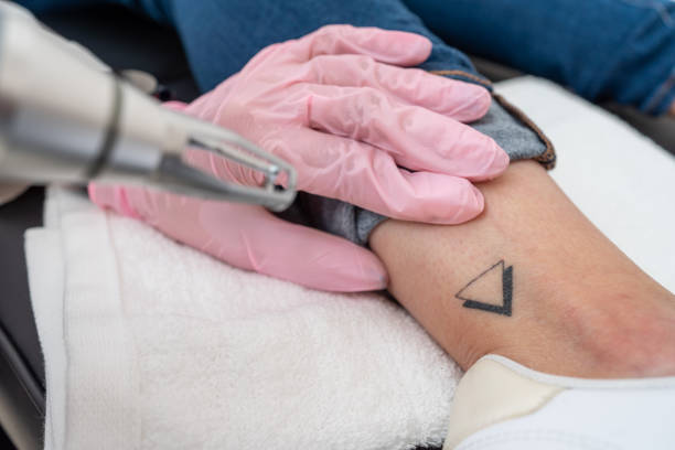 Does Laser Tattoo Removal Work on Multicolored Ink