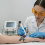 Laser Tattoo Removal in Abu Dhabi