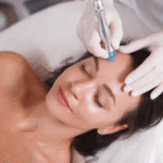 Microneedling for Acne Scars Abu Dhabi