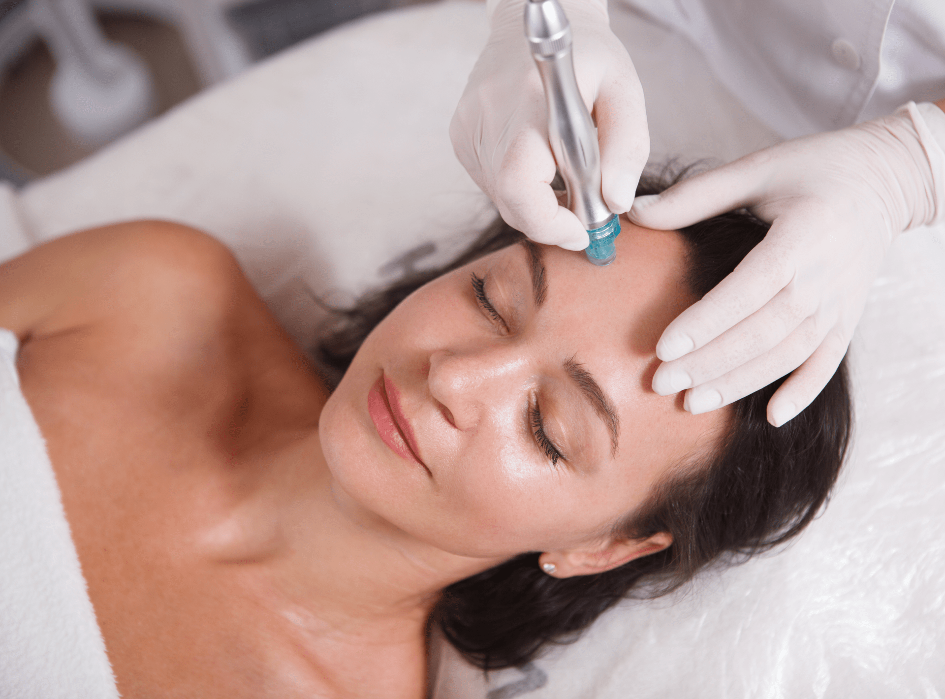 Microneedling for Acne Scars Abu Dhabi