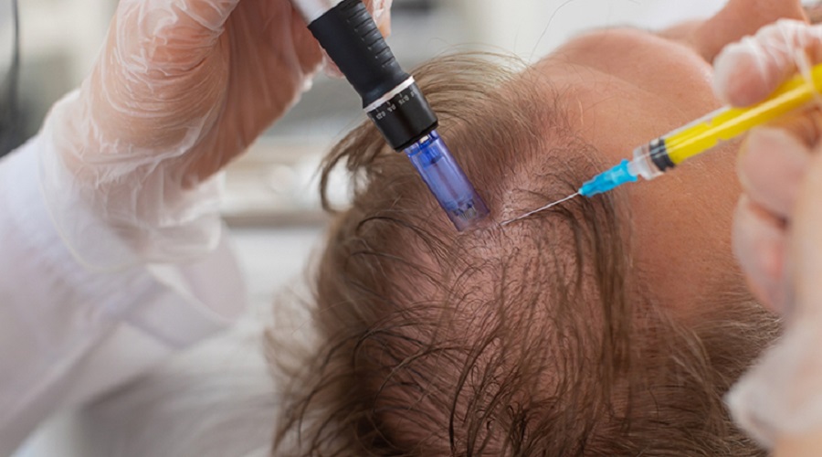 Stem Cell Hair Transplant in Abu Dhabi