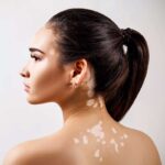 Vitiligo treatment in Abu Dhabi
