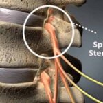 Foraminal Stenosis