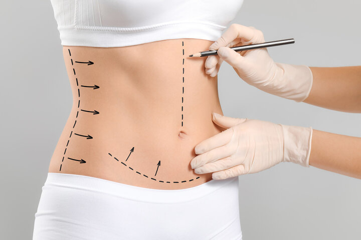 Tummy Tuck Abu Dhabi