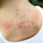Skin Diseases Treatment in Abu Dhabi
