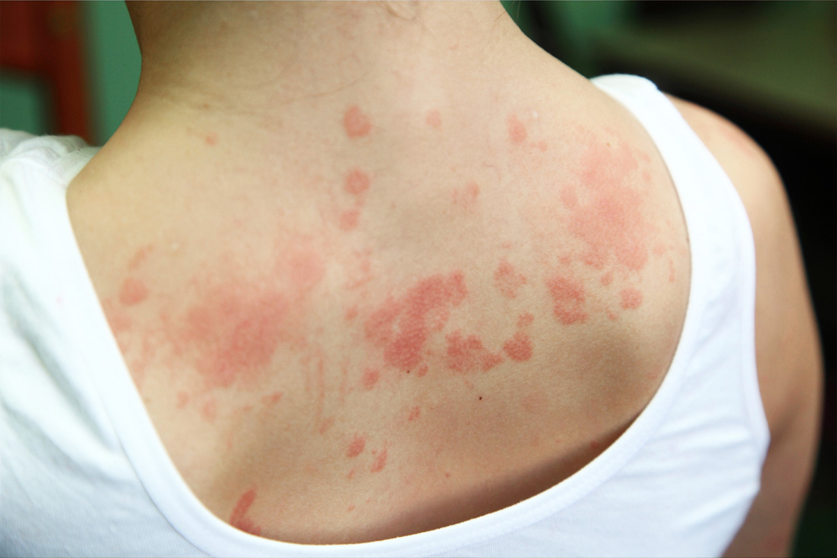 Skin Diseases Treatment in Abu Dhabi