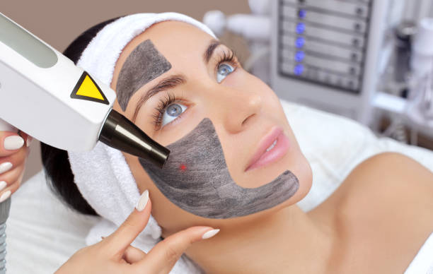 Spectra Laser Carbon Peel in Abu Dhabi