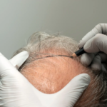 DHI Direct Hair Implant in Abu Dhabi