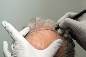 DHI Direct Hair Implant in Abu Dhabi