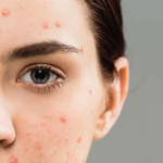 Laser Acne Scar treatment Abu Dhabi