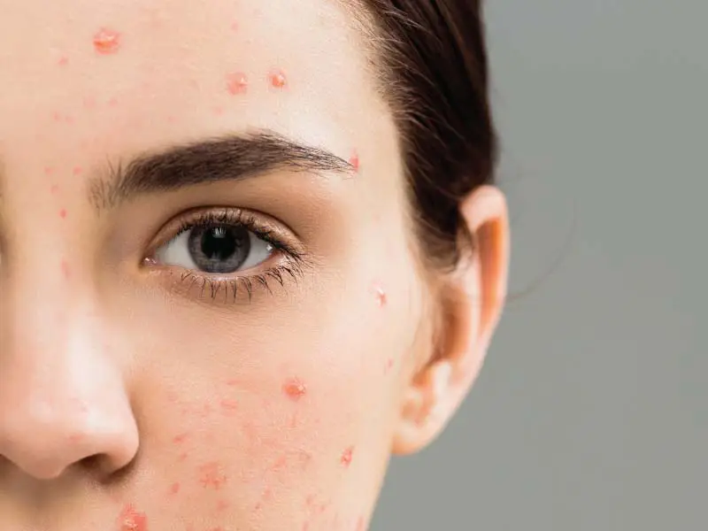 Laser Acne Scar treatment Abu Dhabi
