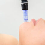 Improve Uneven-Looking Skin Texture with Microneedling Treatment