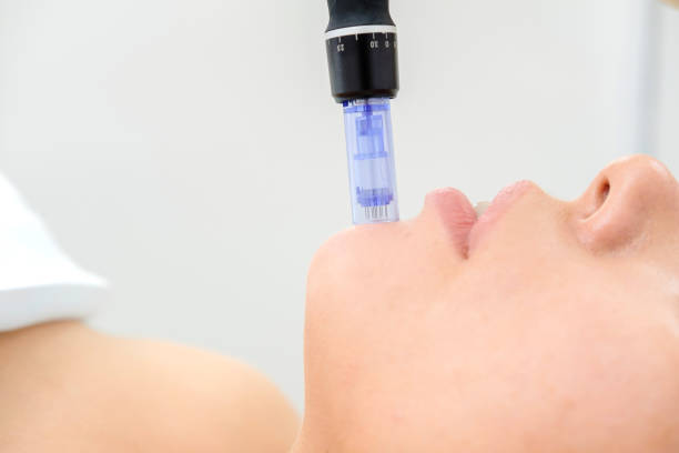 Improve Uneven-Looking Skin Texture with Microneedling Treatment