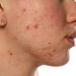 What Acne Treatment Helps Refine Enlarged Pores
