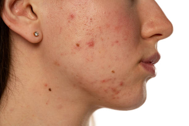 What Acne Treatment Helps Refine Enlarged Pores