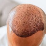 FUE Hair Transplant in Abu Dhabi