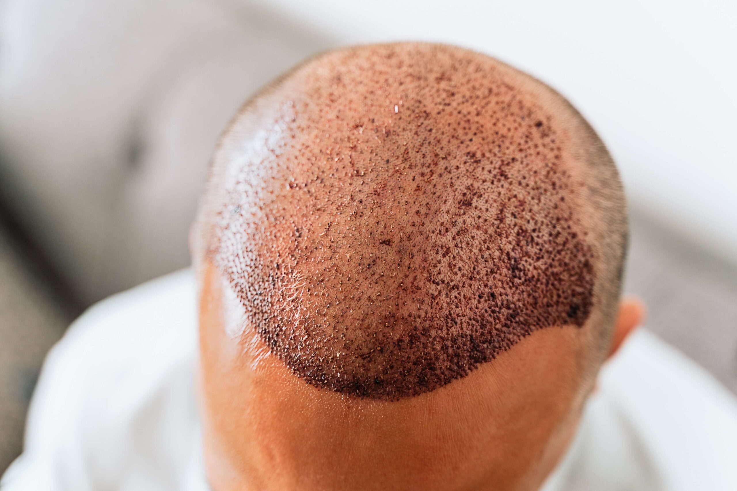 FUE Hair Transplant in Abu Dhabi
