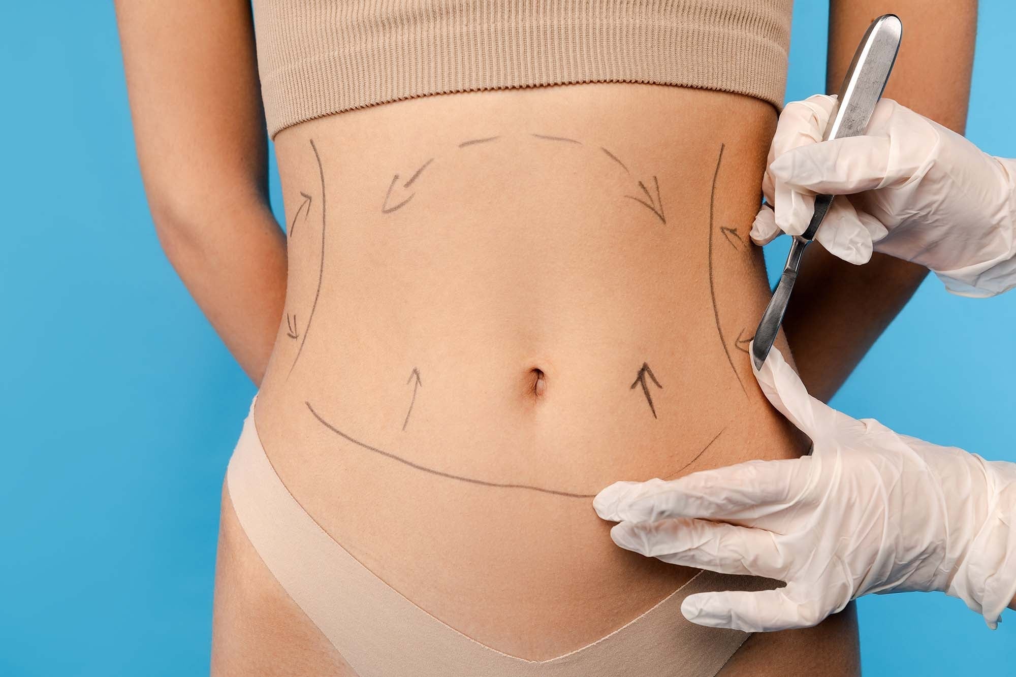 Lipo abdominoplasty in Abu Dhabi