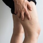 Sclerotherapy in Abu Dhabi