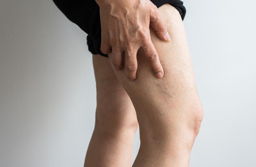 Sclerotherapy in Abu Dhabi
