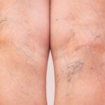 Spider Veins Treatment in Abu Dhabi
