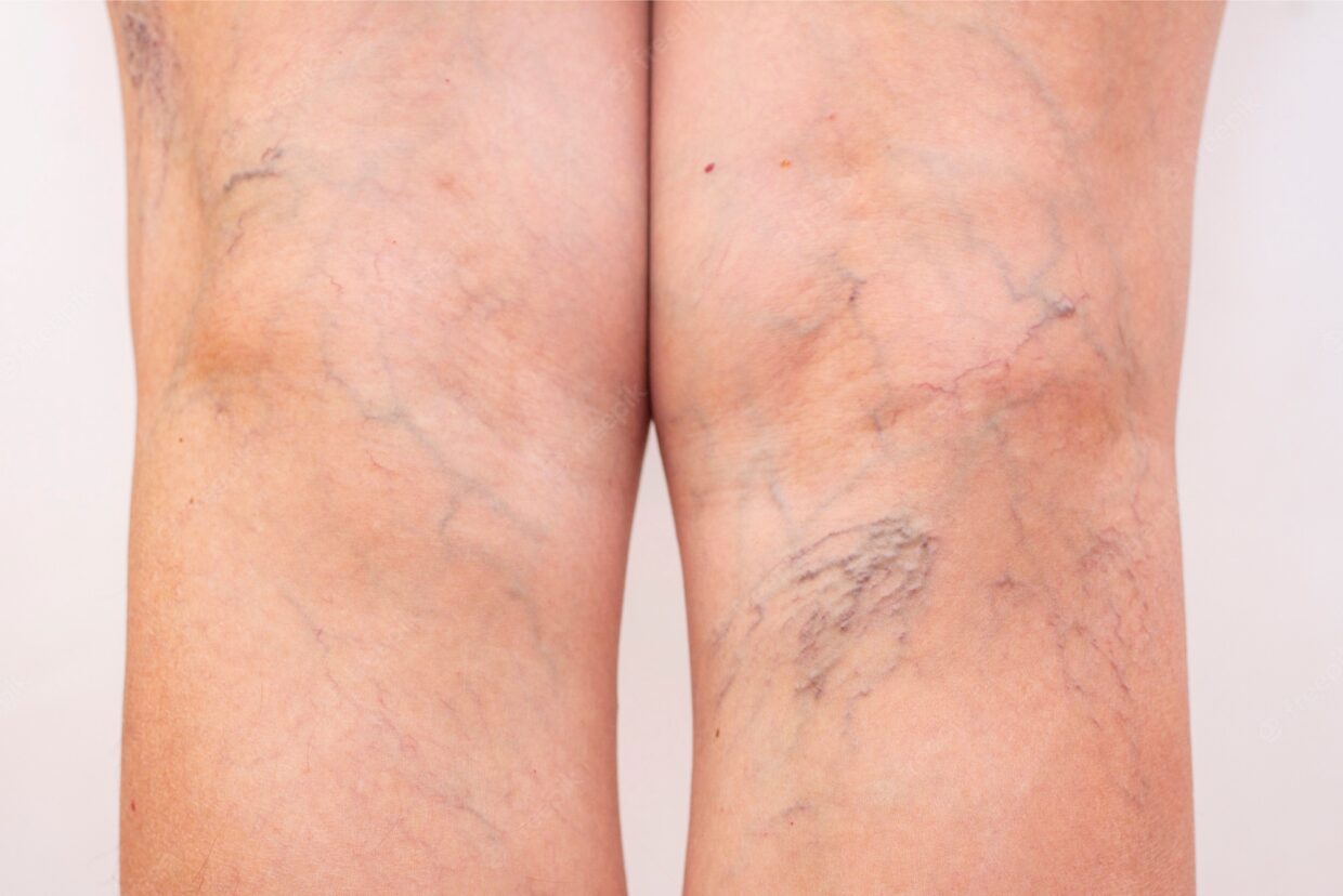 Spider Veins Treatment in Abu Dhabi