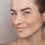 Pigmentation Treatment in Abu Dhabi