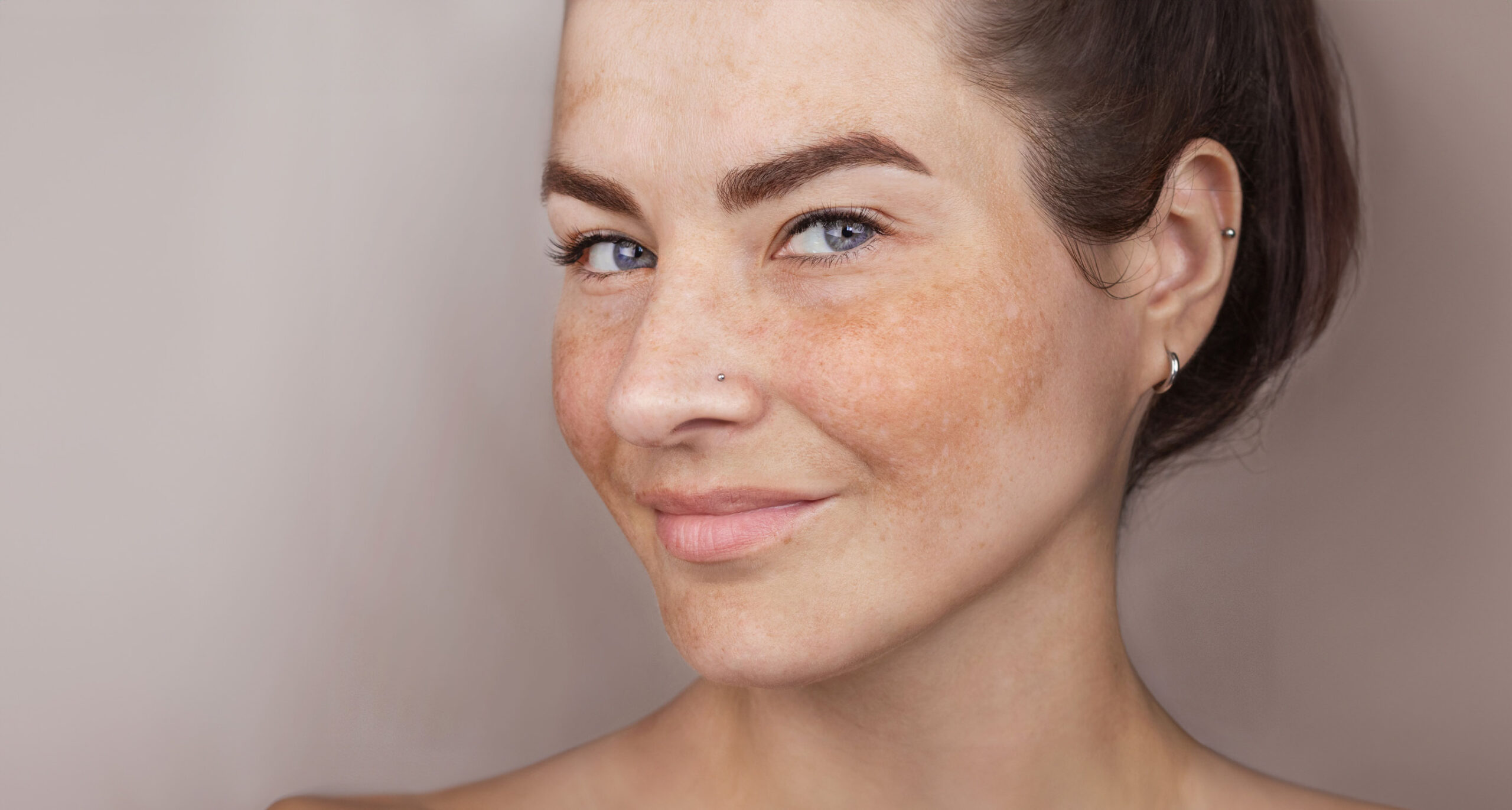 Pigmentation Treatment in Abu Dhabi
