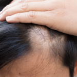 Scalp Micropigmentation Abu Dhabi