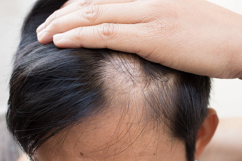 Scalp Micropigmentation Abu Dhabi