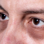 Dark Circles Treatment Abu Dhabi