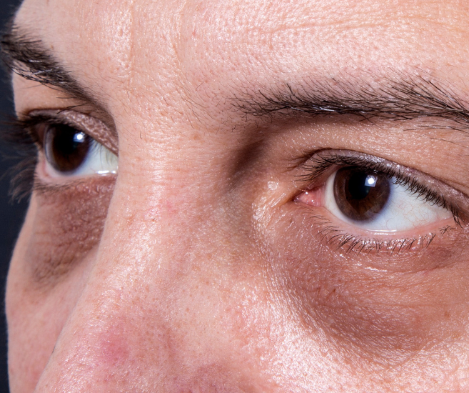 Dark Circles Treatment Abu Dhabi