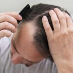 Hair Loss Treatment in Abu Dhabi