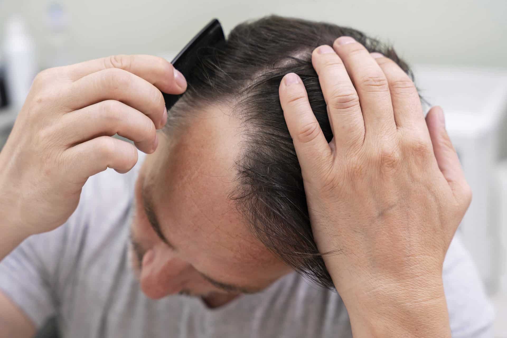 Hair Loss Treatment in Abu Dhabi