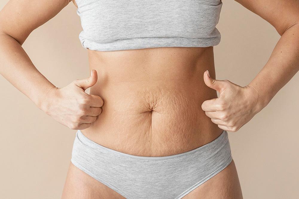 Experience Tailored Abdominal Contouring with Mini Abdominoplasty
