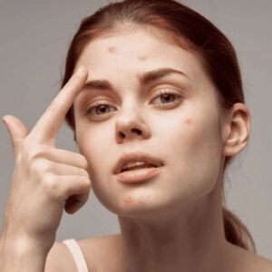 Acne Treatment in Dubai