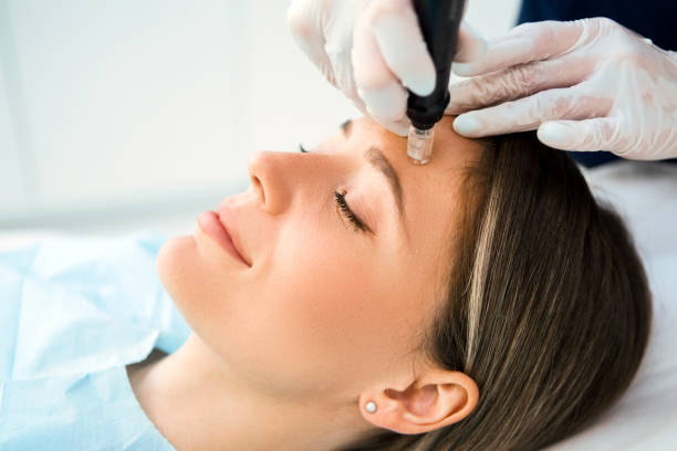 Can Fractional RF Micro Needling Help With Sagging Skin