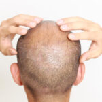 Scalp Micropigmentation Abu Dhabi
