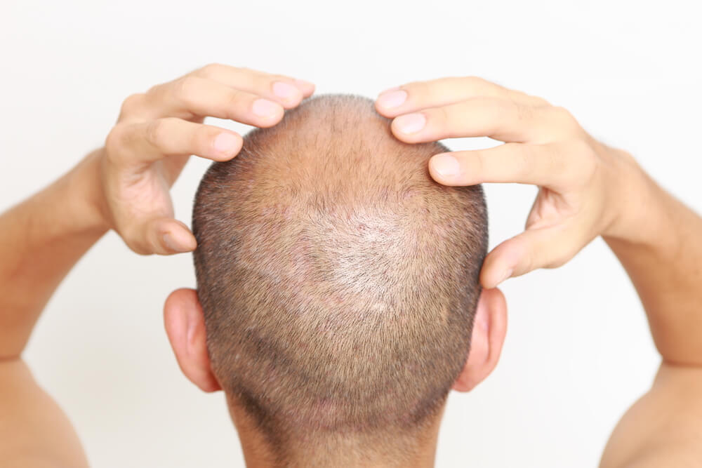 Scalp Micropigmentation Abu Dhabi